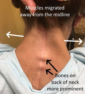 Posterior-neck-muscles-migr-lat-Cross.jpg