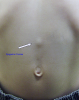 Epigastric-Hernia.png