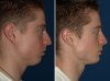 chin-implant-1-right.jpg