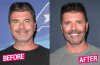 Simon-Cowell-Before-After-Plastic-Surgery-Photos-05.jpg