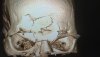 evangelista-santos-bellator-158-skull-scan-xray.jpg