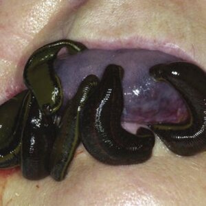 Medicinal-leeches-applied-to-the-tongue_Q320.jpg