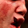 Lawlers Lip Laceration